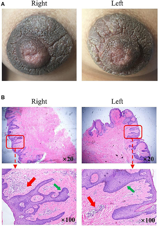 Why Do Some Women Have Large Areolas