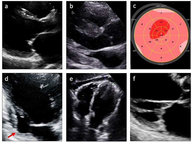 Diagnostic and predictive value of speckle tracking echocardiography in  cardiac sarcoidosis, BMC Cardiovascular Disorders