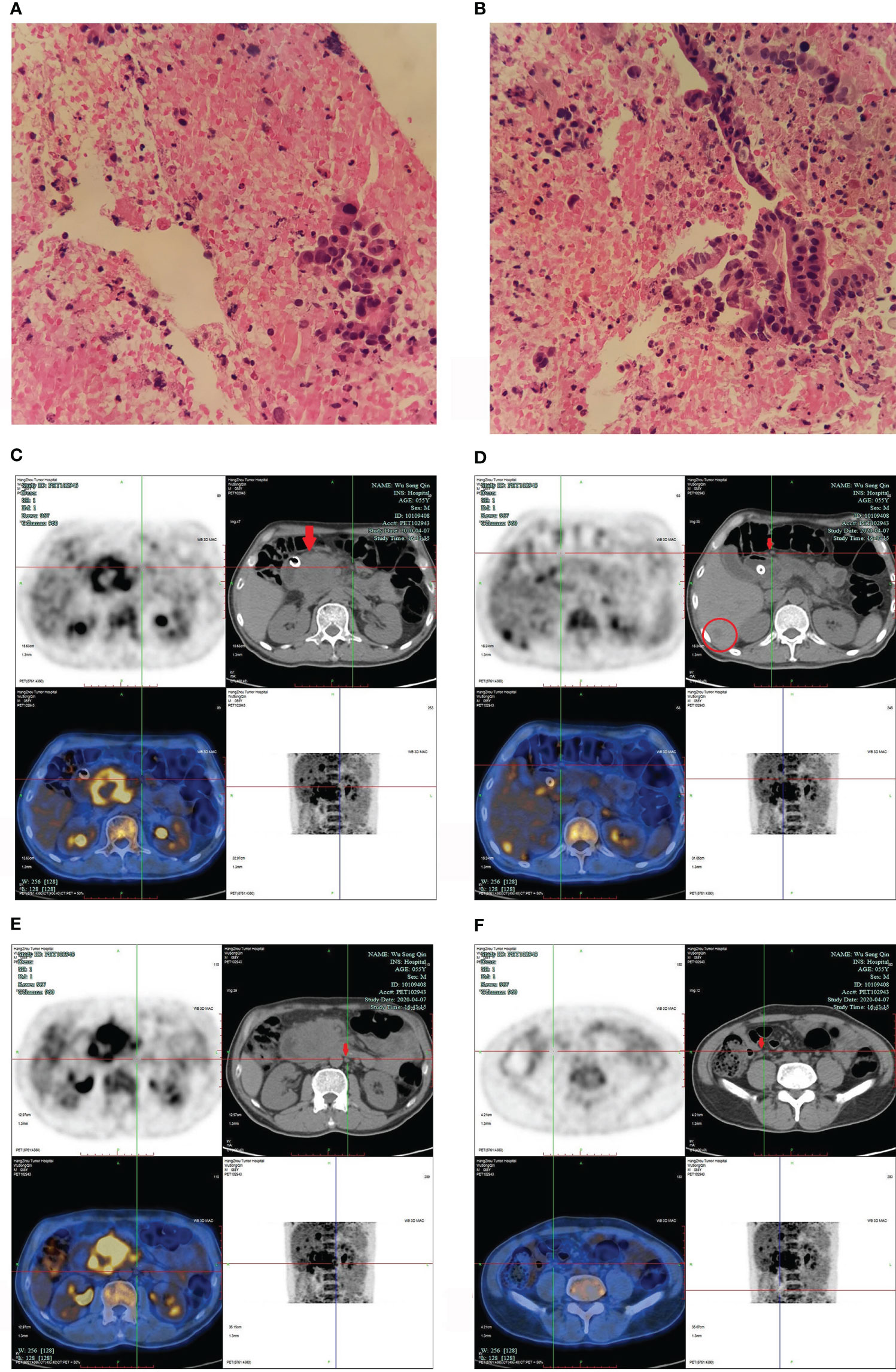 Frontiers Successful Immunotherapy for Pancreatic Cancer in a Patient