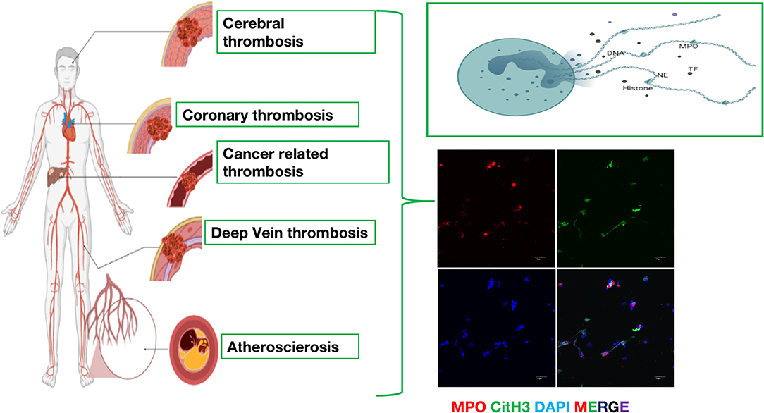 Frontiers  The Significance of Neutrophil Extracellular Traps in