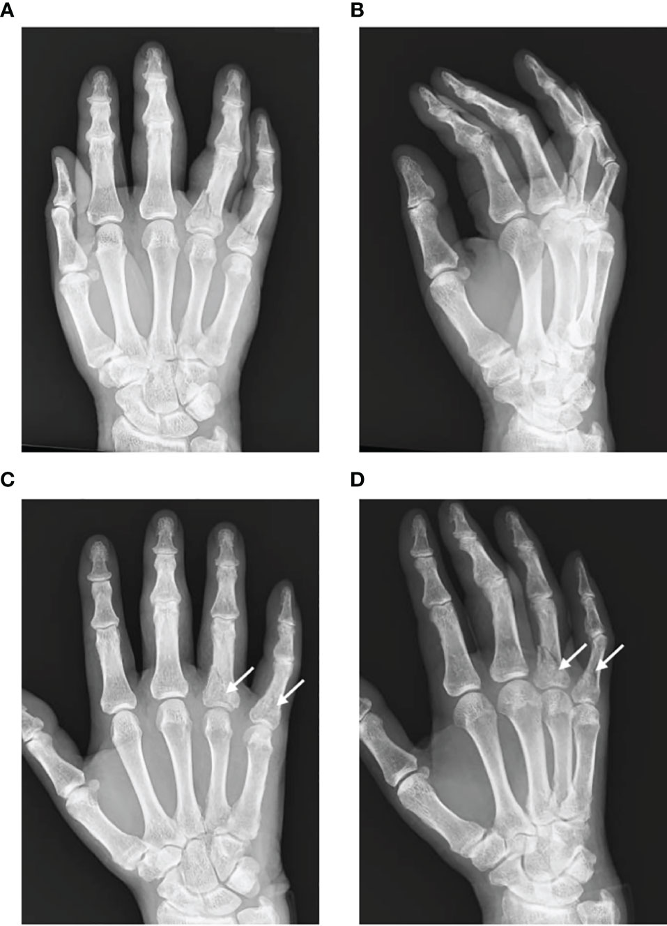 Frontiers  Electrical Stimulation of Acute Fractures: A Narrative