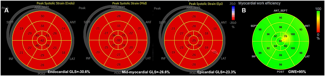 Practical assessment of myocardial work. a Global longitudinal strain