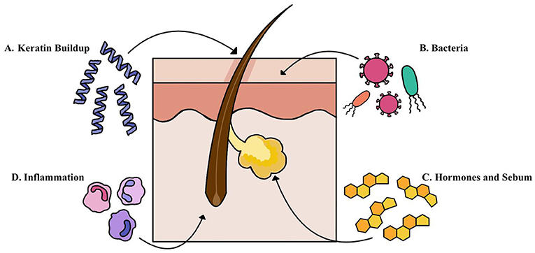 What Is Acne And What Causes It Frontiers For Young Minds what-is-acne-and-what-causes-it-frontiers-for-young-minds