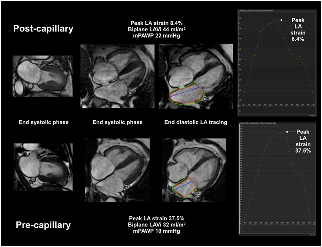 Strain imaging using cardiac magnetic resonance