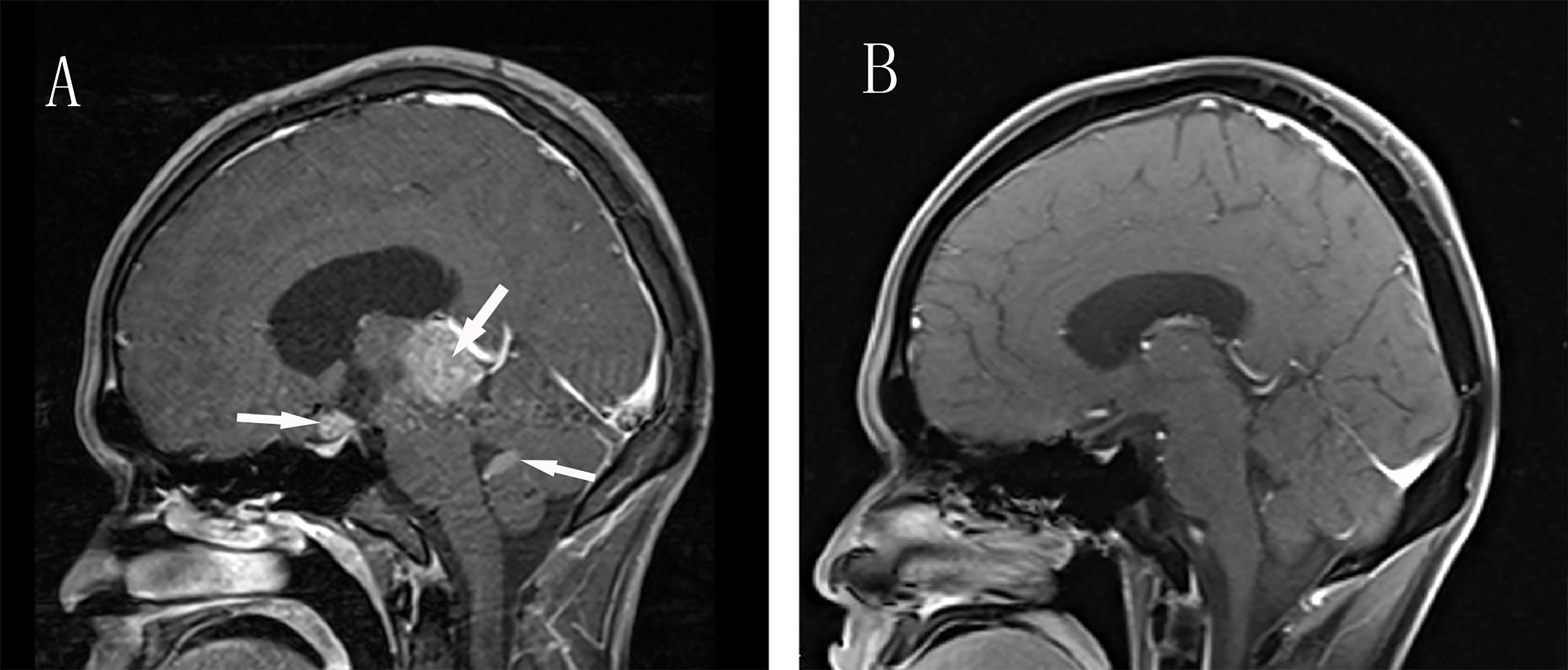 Frontiers  Multiple ectopic recurrent germ cell tumors after