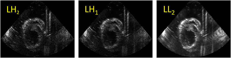 Advances in echocardiography: global longitudinal strain, intra-cardiac  multidirectional flow imaging and automated 3d volume analysis