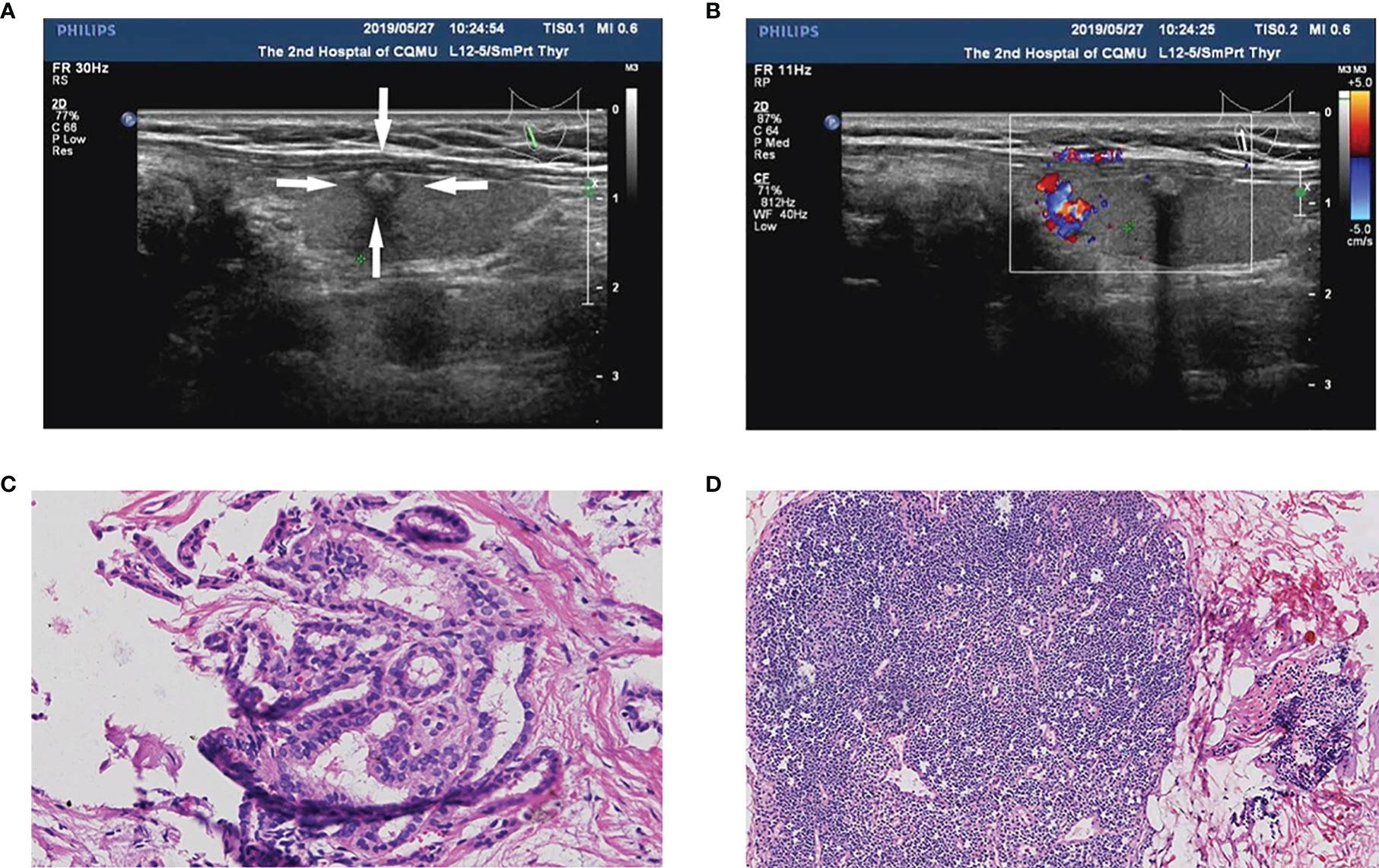 Frontiers Predictors And A Prediction Model For Central Cervical