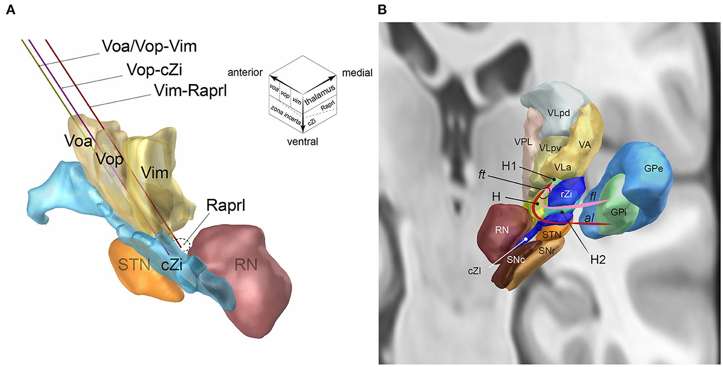 Frontiers A Single DBS Lead To Stimulate The Thalamus And Subthalamus 