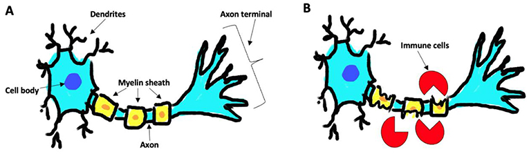 Figure 1 - (A) A healthy neuron, with an intact myelin sheath, can send signals effectively.