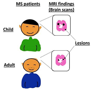 Figure 2 - MRI scans are used to diagnose MS in both children and adults.