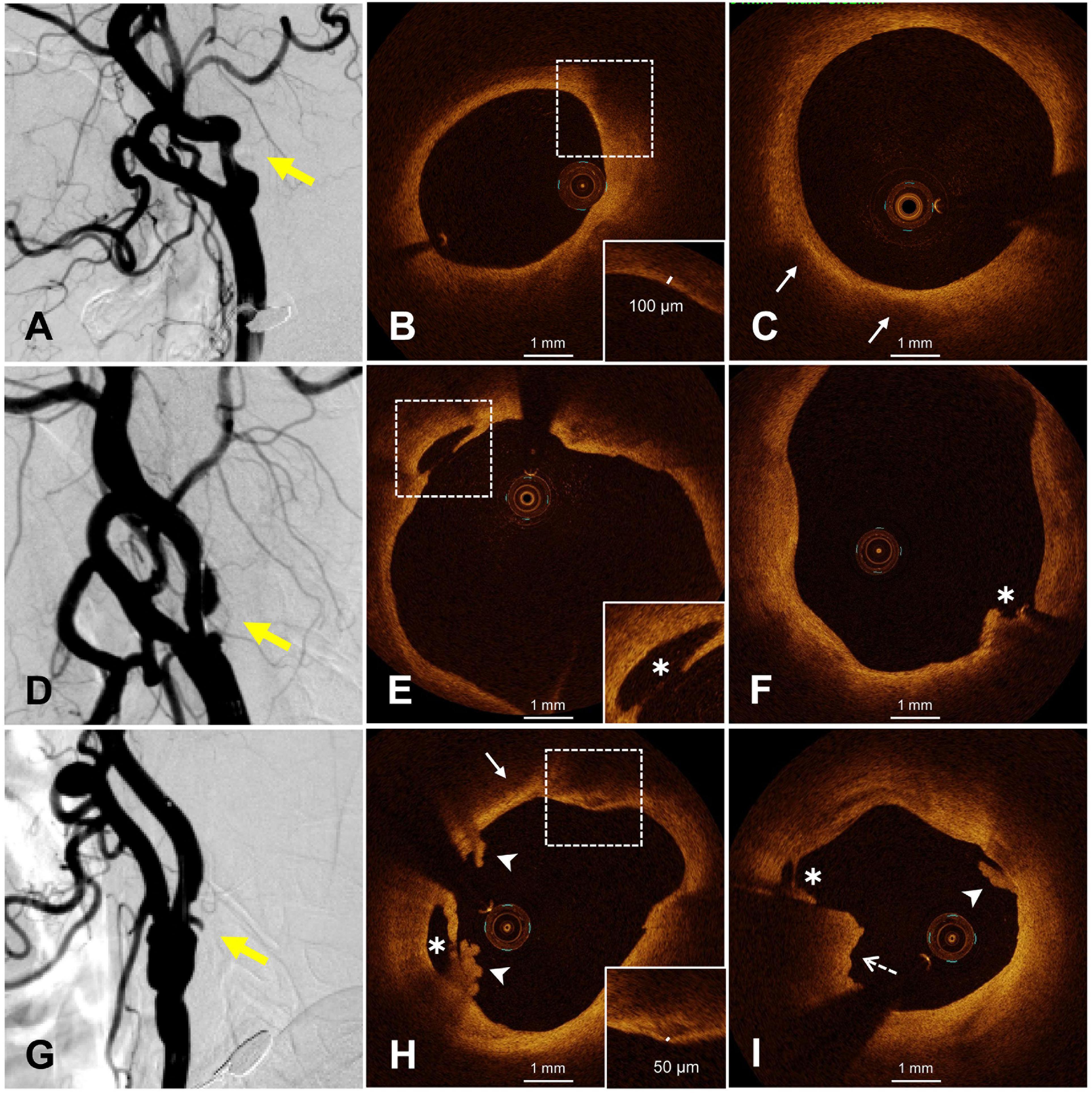 Frontiers  Characteristics and evaluation of atherosclerotic plaques: an  overview of state-of-the-art techniques