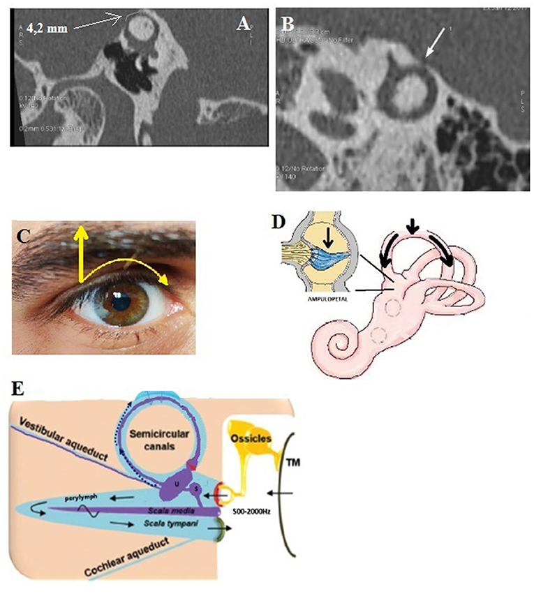 Frontiers  Audiovestibular Quantification in Rare Third Window