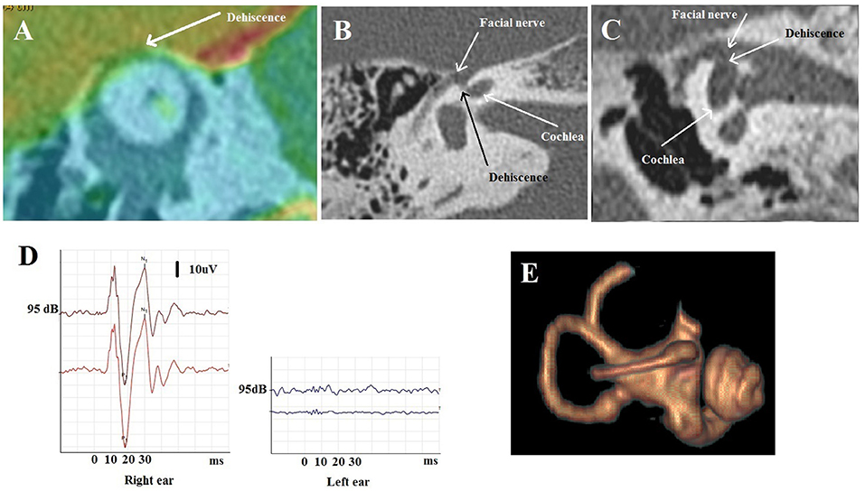 Frontiers  Audiovestibular Quantification in Rare Third Window