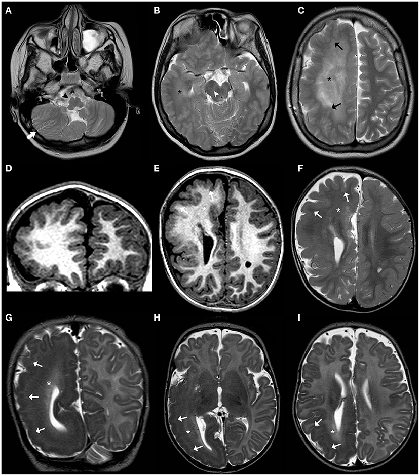 Robinow Syndrome: Most Up-to-Date Encyclopedia, News & Reviews