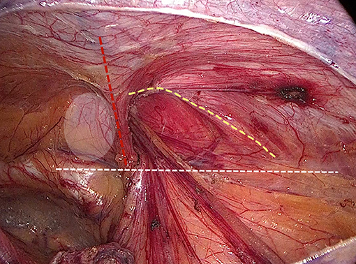 Frontiers  Internal Ring Defect Closure Technique in Laparoscopic Mesh  Hernioplasty for Indirect Inguinal Hernia
