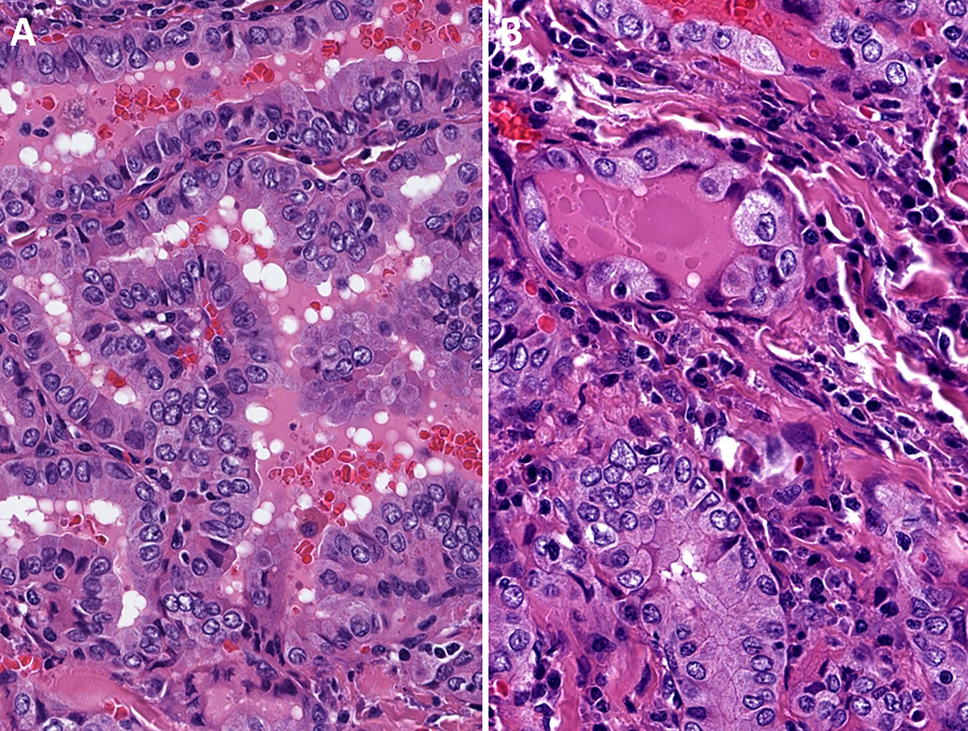 papillary thyroid carcinoma gross