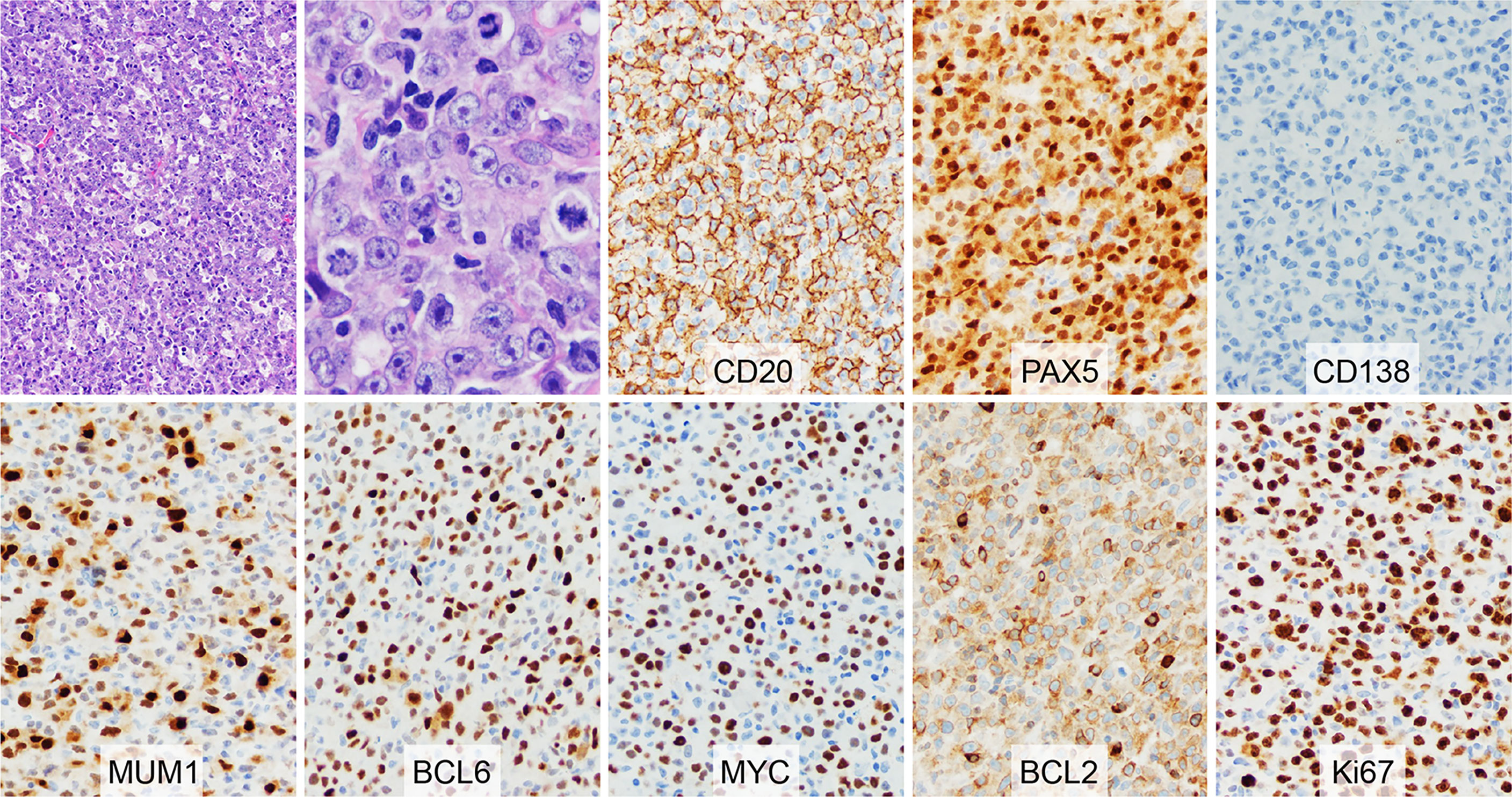 Frontiers | Case Report: Phenotypic Switch in High-Grade B-Cell