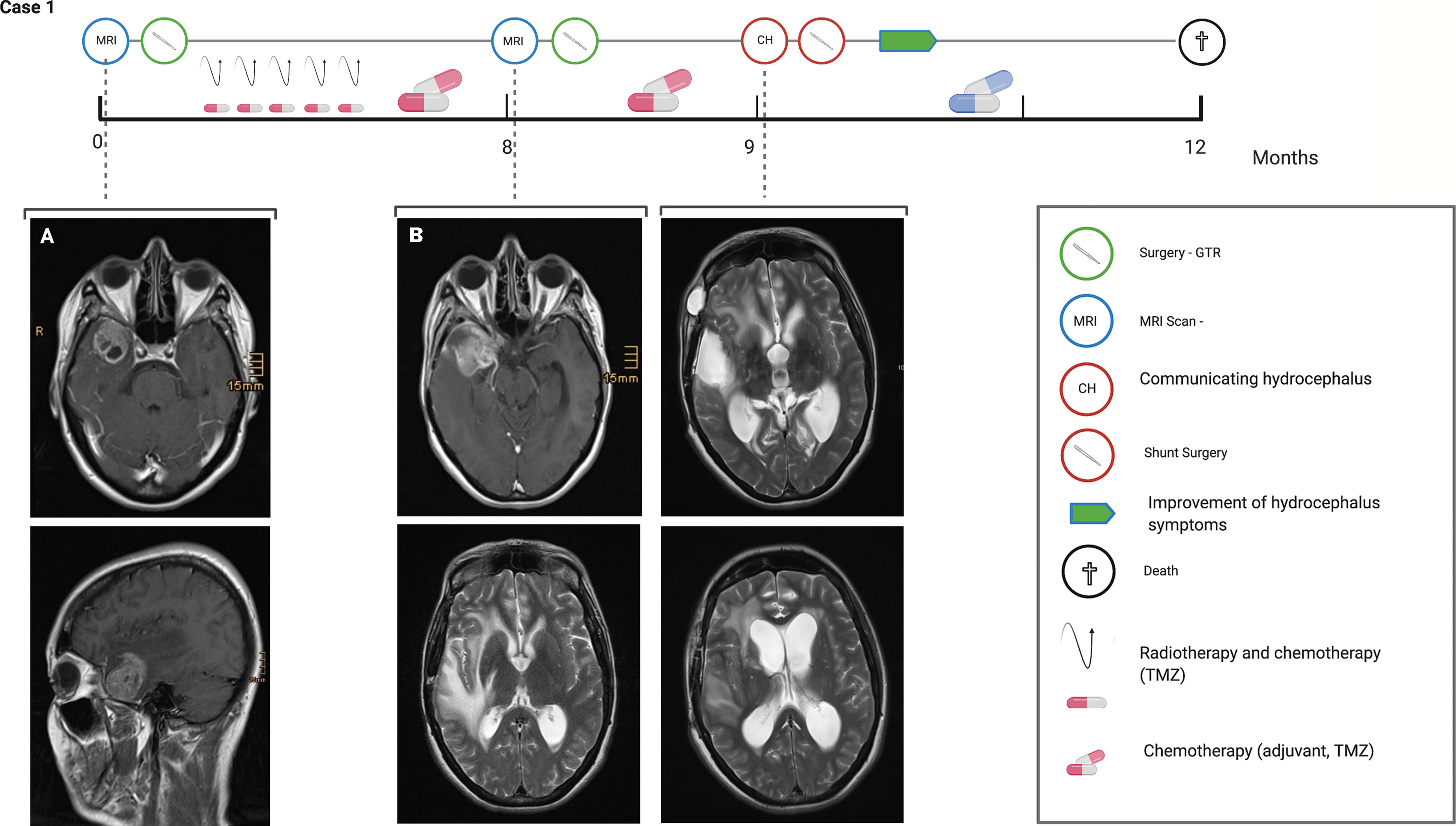 Hydrocephalus and Shunts, Fact Sheet, Health Information