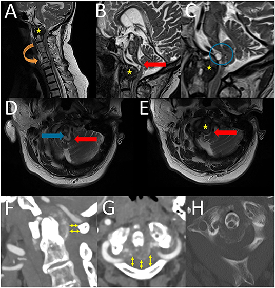 MRI of THORACOLUMBAR SPINE IMPRESSION: Moderate Pathological