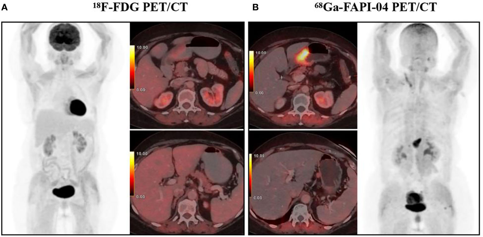 PET Imaging of Fibroblast Activation Protein in Various Types of Cancer  Using 68Ga-FAP-2286: Comparison with 18F-FDG and 68Ga-FAPI-46 in a  Single-Center, Prospective Study
