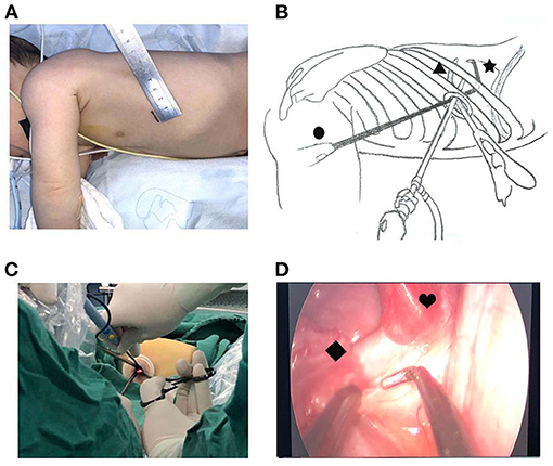 Minimal access surgery conducted to rescue infant from Rare Chest Cyst in  Pune