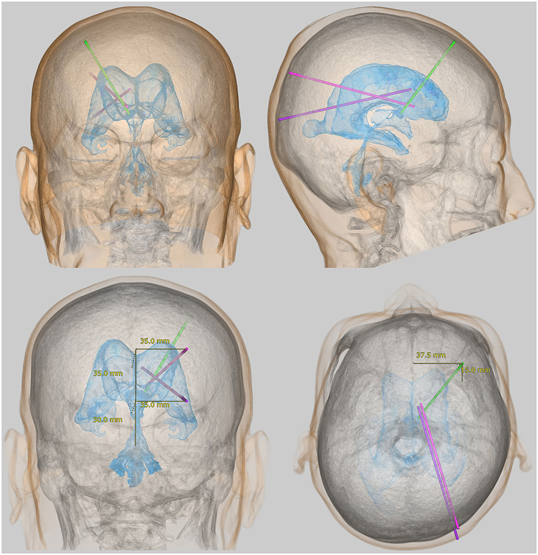 Having a Ventriculoperitoneal Shunt