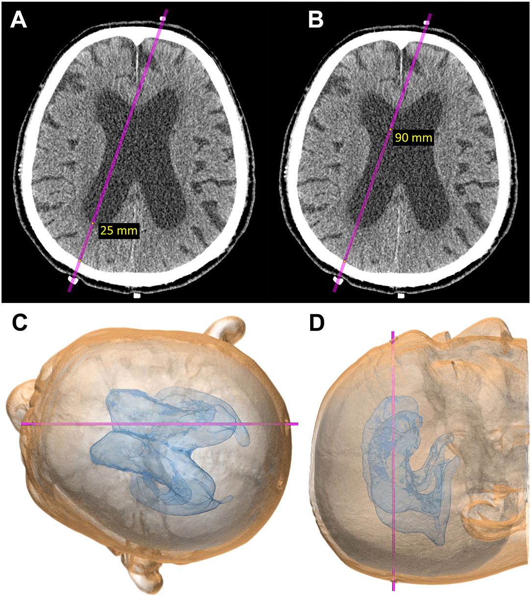 Cerebrospinal shunts - Questions and Answers ​in MRI