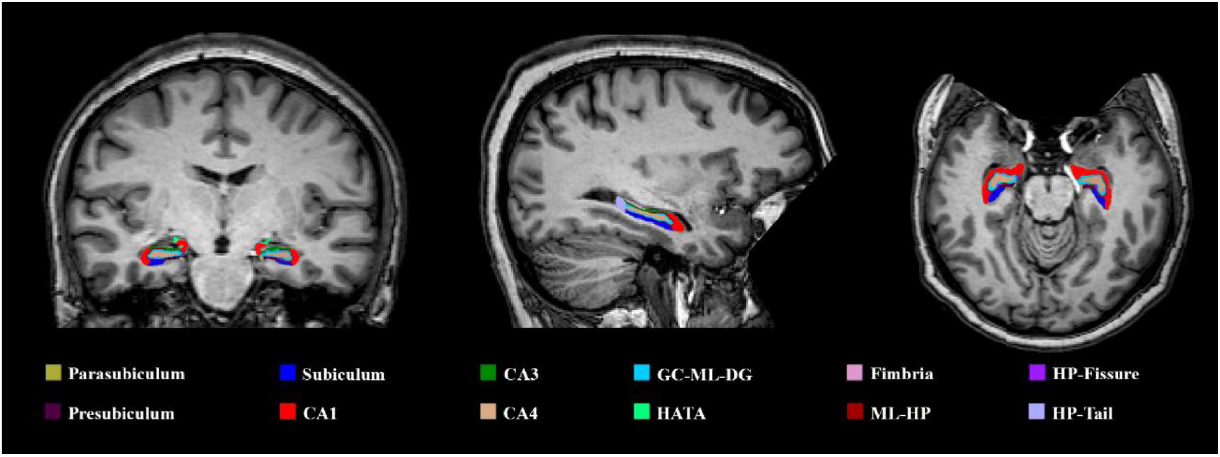 Frontiers  Fully Automatic Classification of Brain Atrophy on NCCT Images  in Cerebral Small Vessel Disease: A Pilot Study Using Deep Learning Models