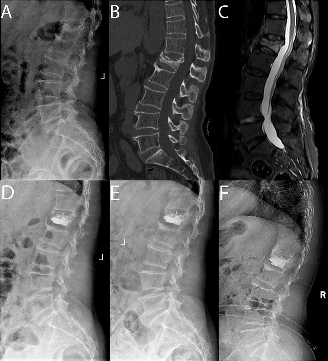 Acute osteoporotic compression fracture - L5