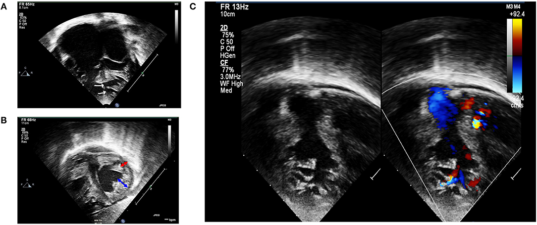 Nakata index above 1500 mm2/m2 predicts death in absent pulmonary valve  syndrome - Congenital Heart International Professionals (CHiP) Network