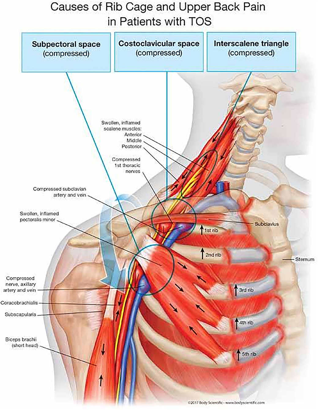 1039px x 1339px - Frontiers | Diagnostic and Therapeutic Management of the Thoracic Outlet  Syndrome. Review of the Literature and Report of an Italian Experience