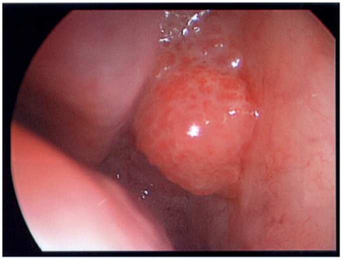 benign tumor inverted papilloma