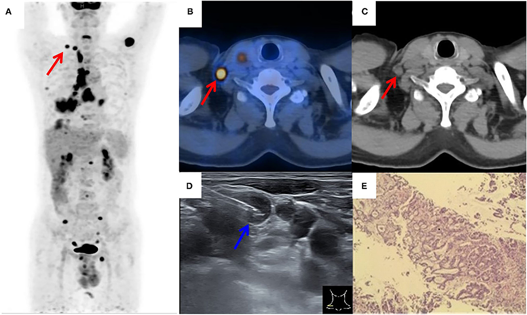 Frontiers Performance Of Ultrasound Guided Core Biopsy Driven By Fdg
