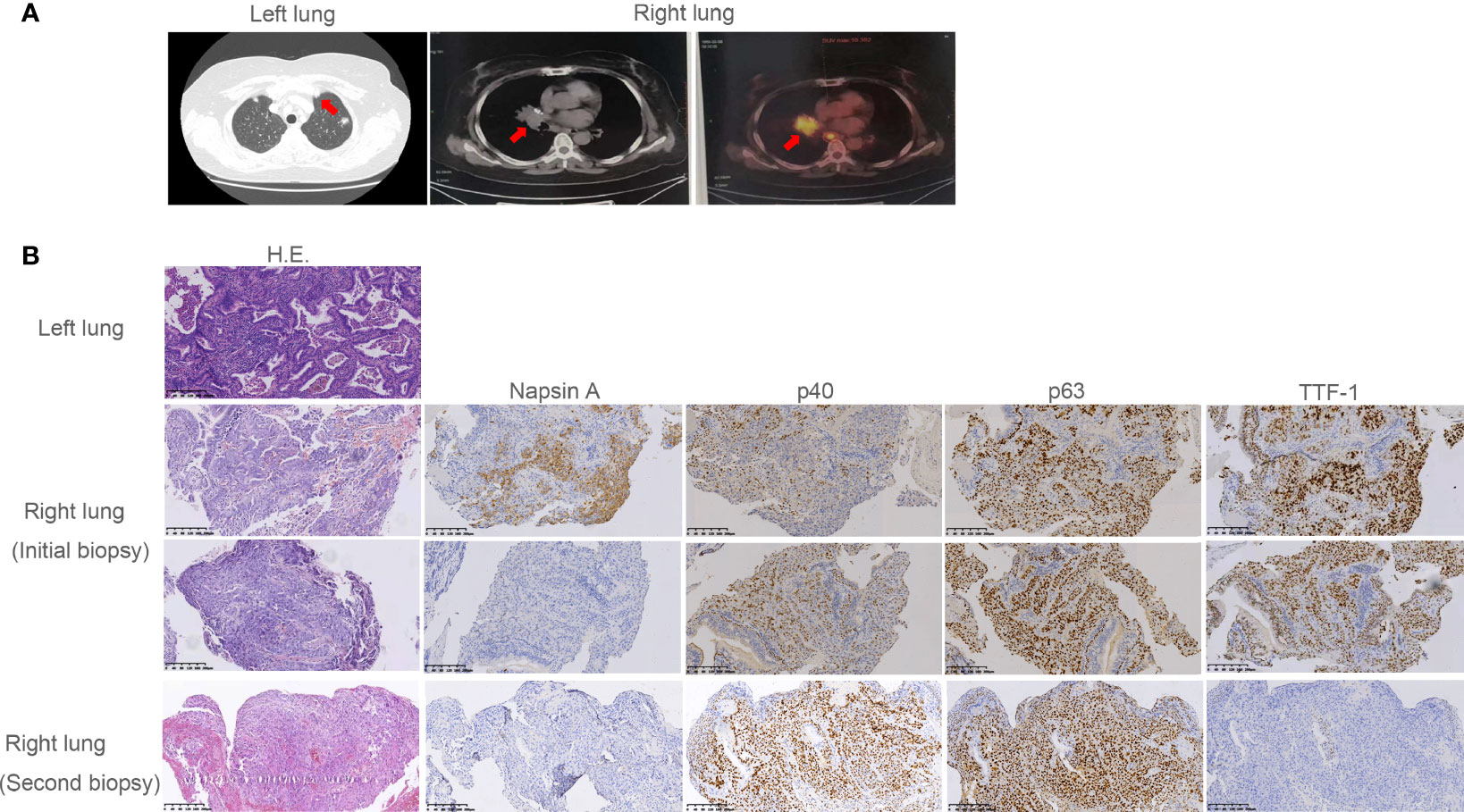 Frontiers | Case Report: Dramatic Response to Crizotinib in a Patient With  Non-Small Cell Lung Cancer Positive for a Novel ARL1-MET Fusion