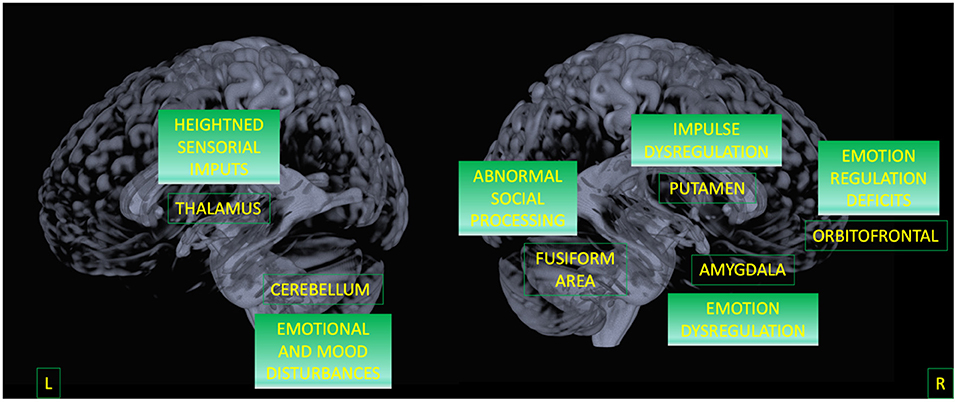 Cureus, Structural MRI Brain Alterations in Borderline Personality Disorder  and Bipolar Disorder