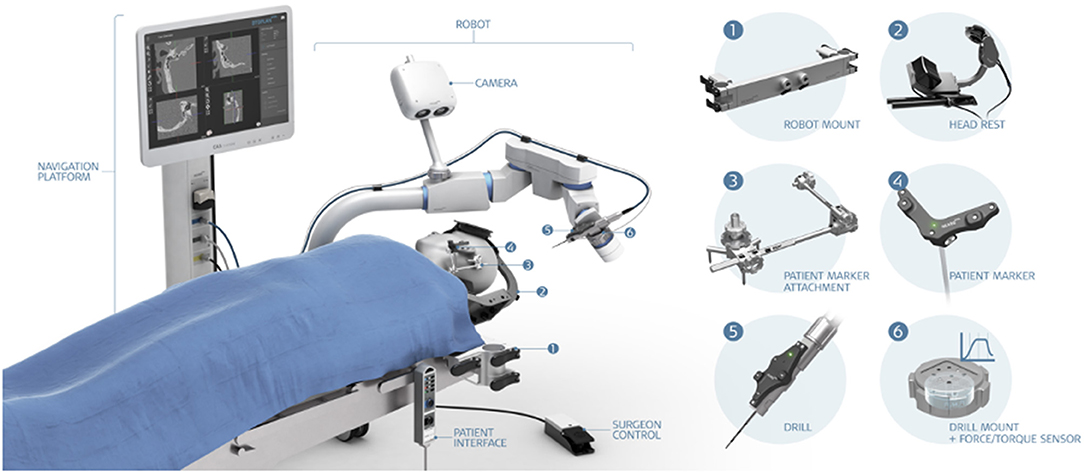 First robotic-assisted intracranial implant of Cerus Endovascular contour  intrasaccular device - NeuroNews International