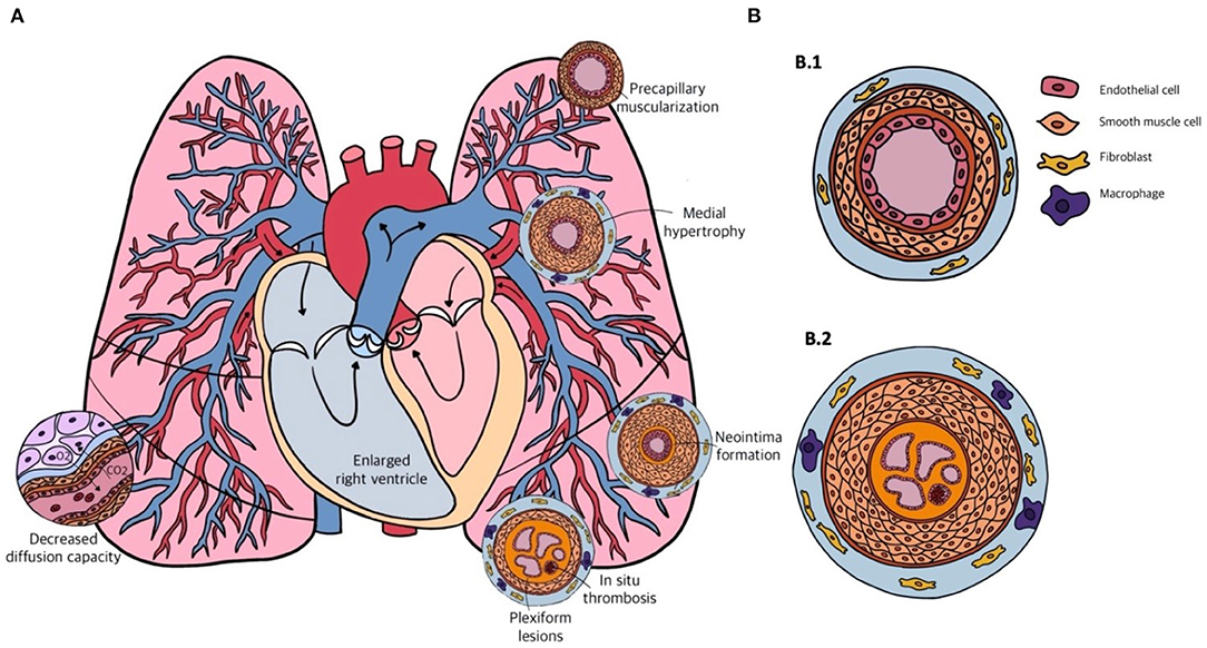 pulmonary artery hypertension