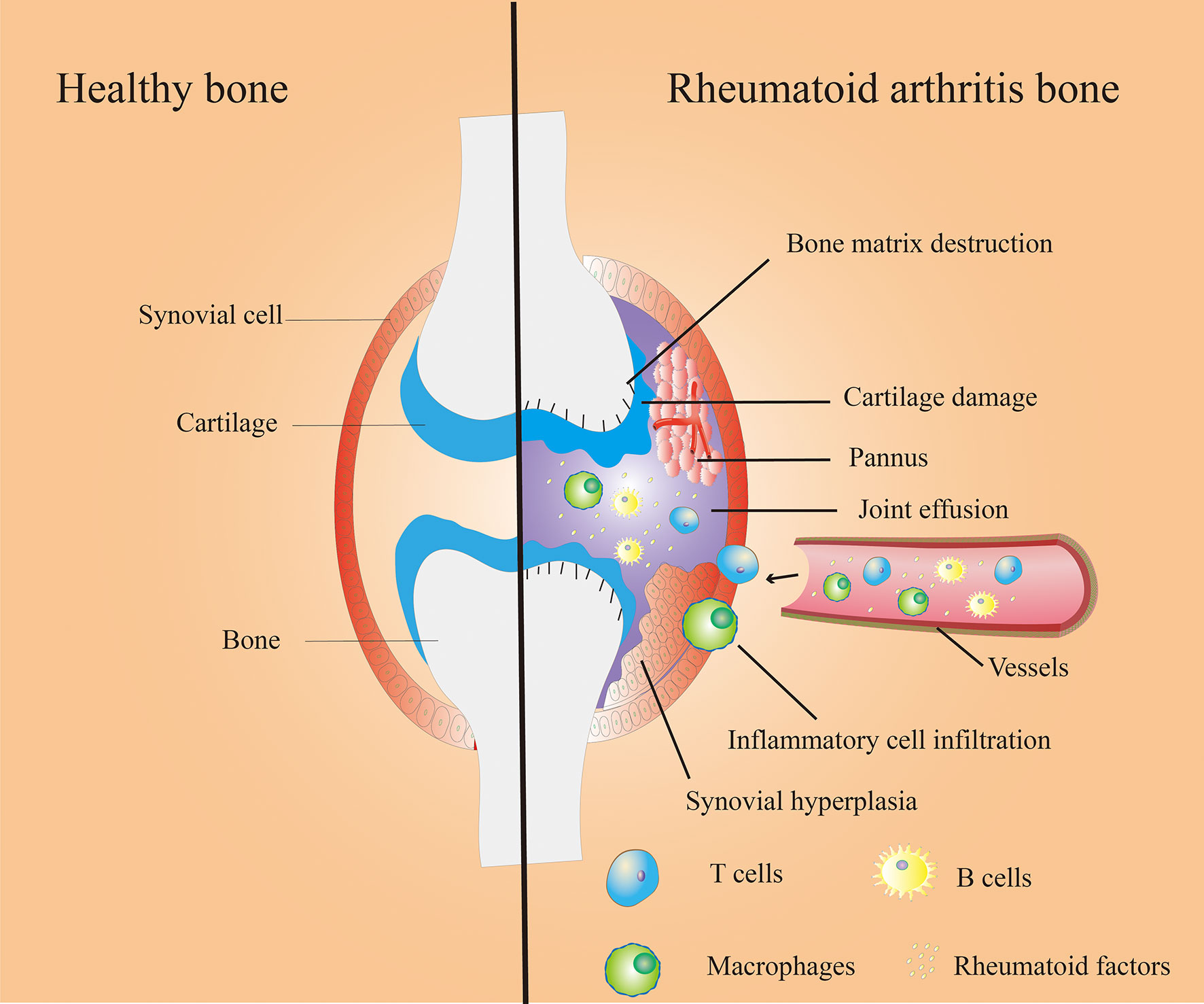 rheumatoid arthritis pathogenesis review)