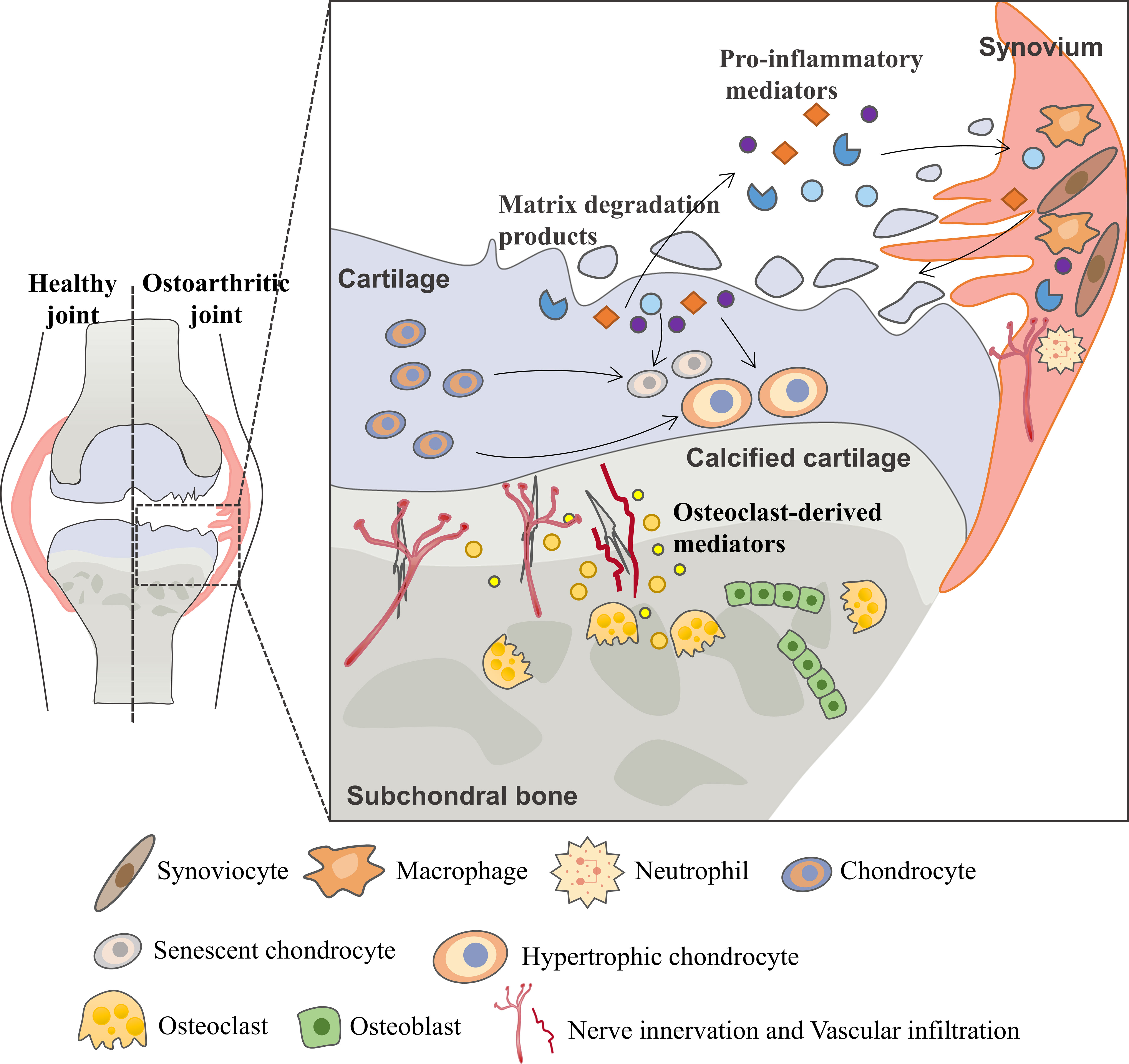 osteoarthritis kor