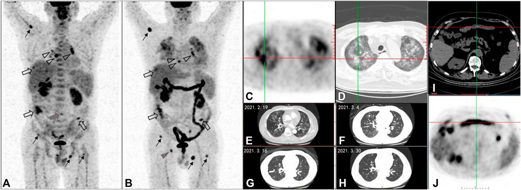 pet scan colon cancer