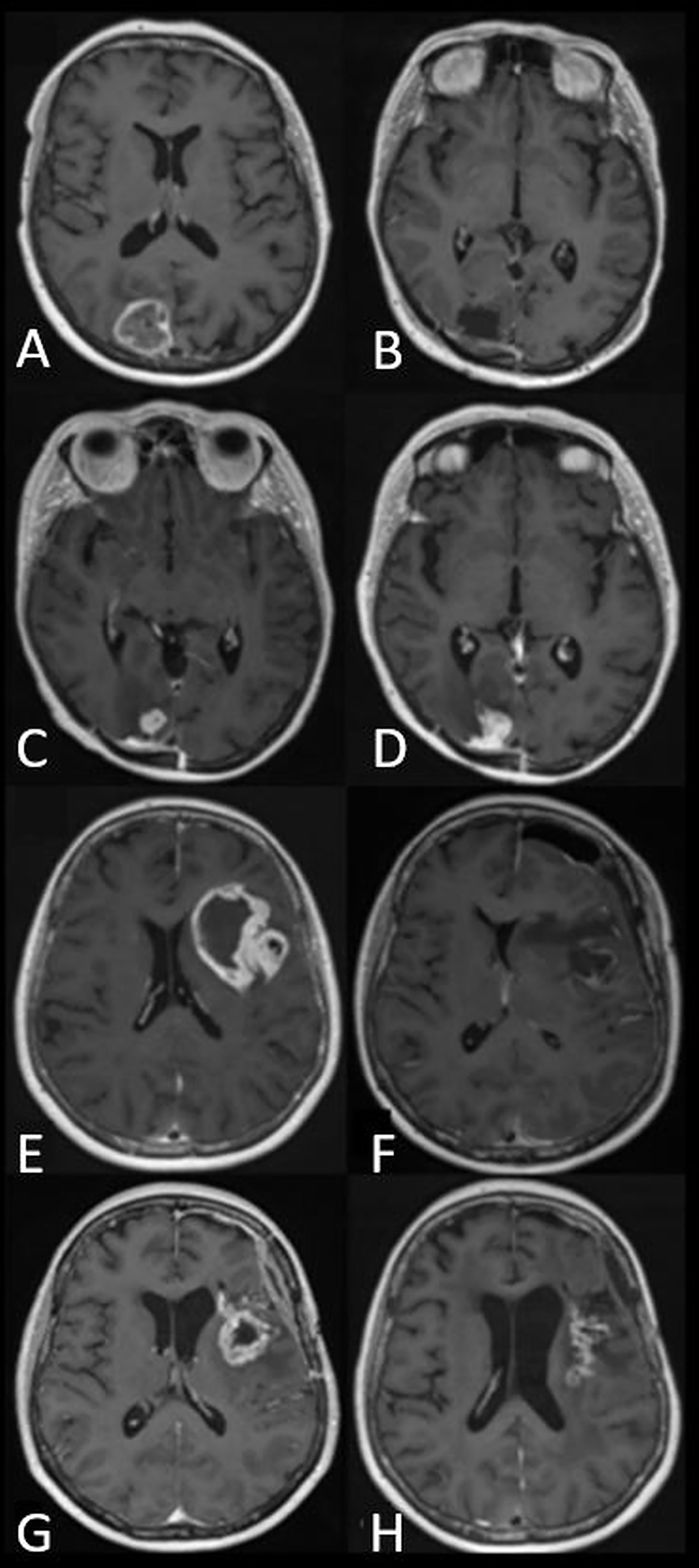 End Stage Glioblastoma Patient Bettye Field