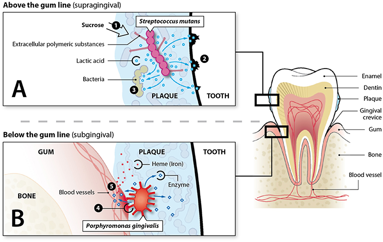 Figure 1 - Bacteria living above and below the gumline can damage the teeth and gums.
