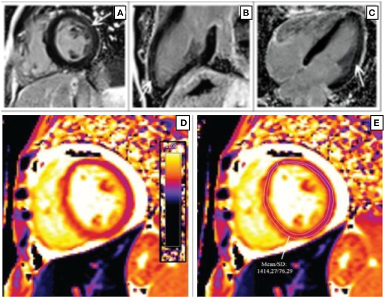 Frontiers  Multi-Modality Imaging in Dilated Cardiomyopathy: With a Focus  on the Role of Cardiac Magnetic Resonance