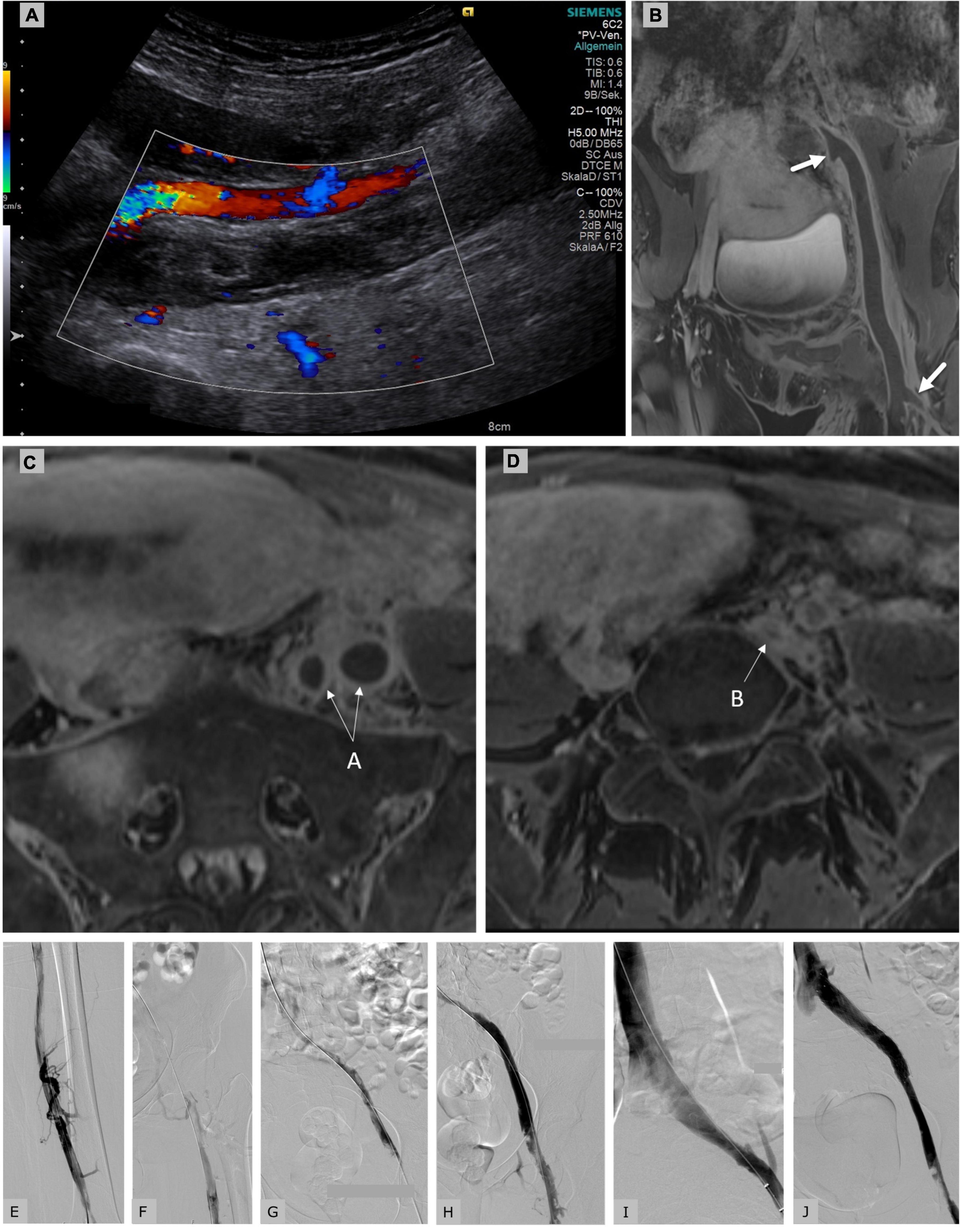 Frontiers CatheterDirected Thrombolysis for Postpartum Deep Venous
