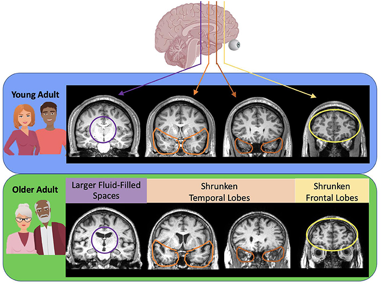图 1 - 年轻人和老年人大脑的 MRI 图像。