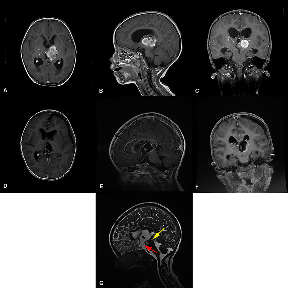 Frontiers | Risk Factors for Early Hydrocephalus on Post Unilateral ...