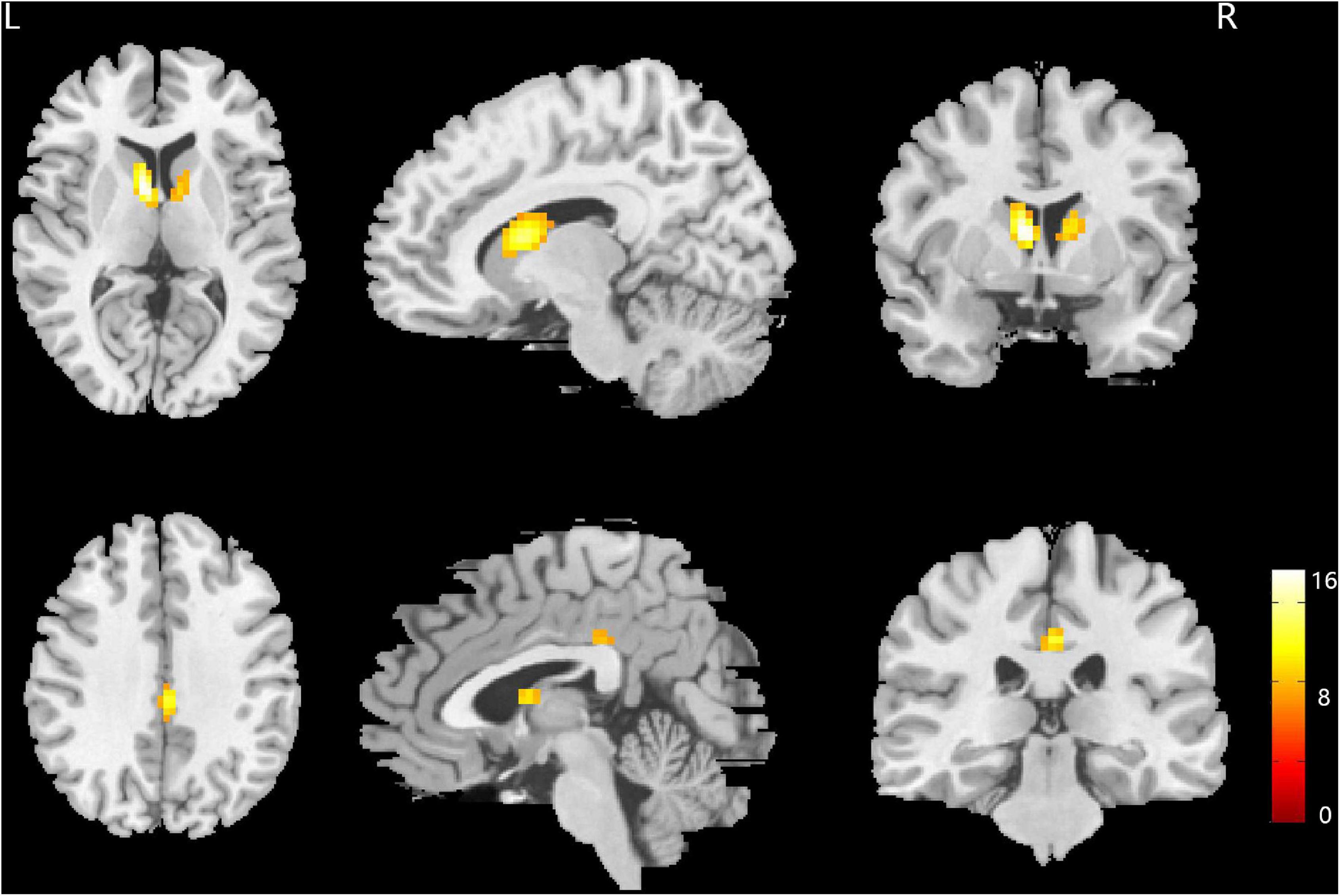 Frontiers  Neural activity in adults with major depressive disorder  differs from that in healthy individuals: A resting-state functional  magnetic resonance imaging study