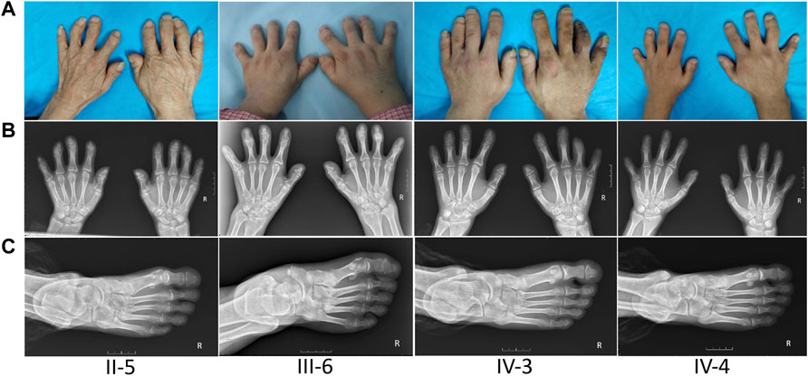 Brachydactyly Types - Causes & Outlook