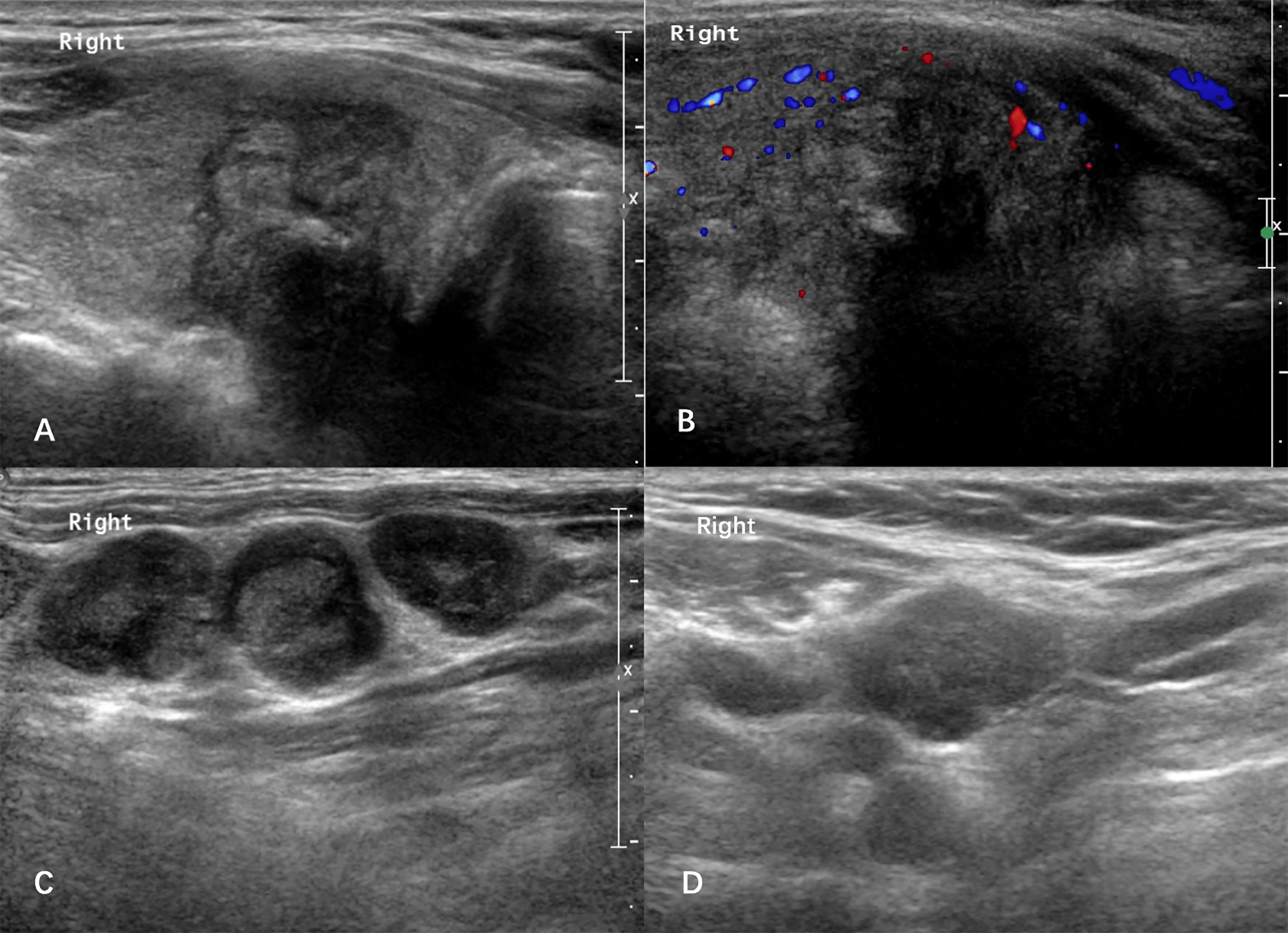 Frontiers Large Volume Lateral Lymph Node Metastasis Predicts Worse