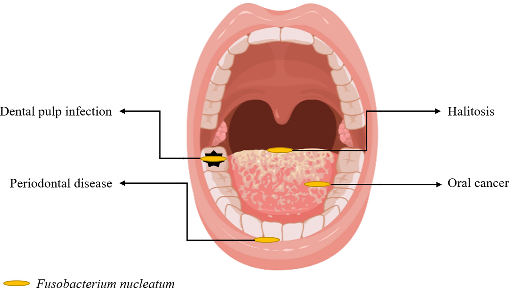 Frontiers | More Than Just a Periodontal –the Research Progress Fusobacterium